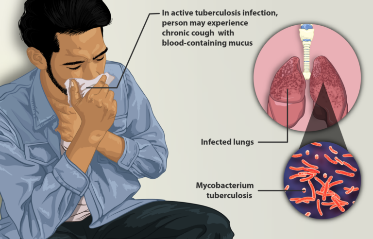 1200px-Depiction_of_a_tuberculosis_patient